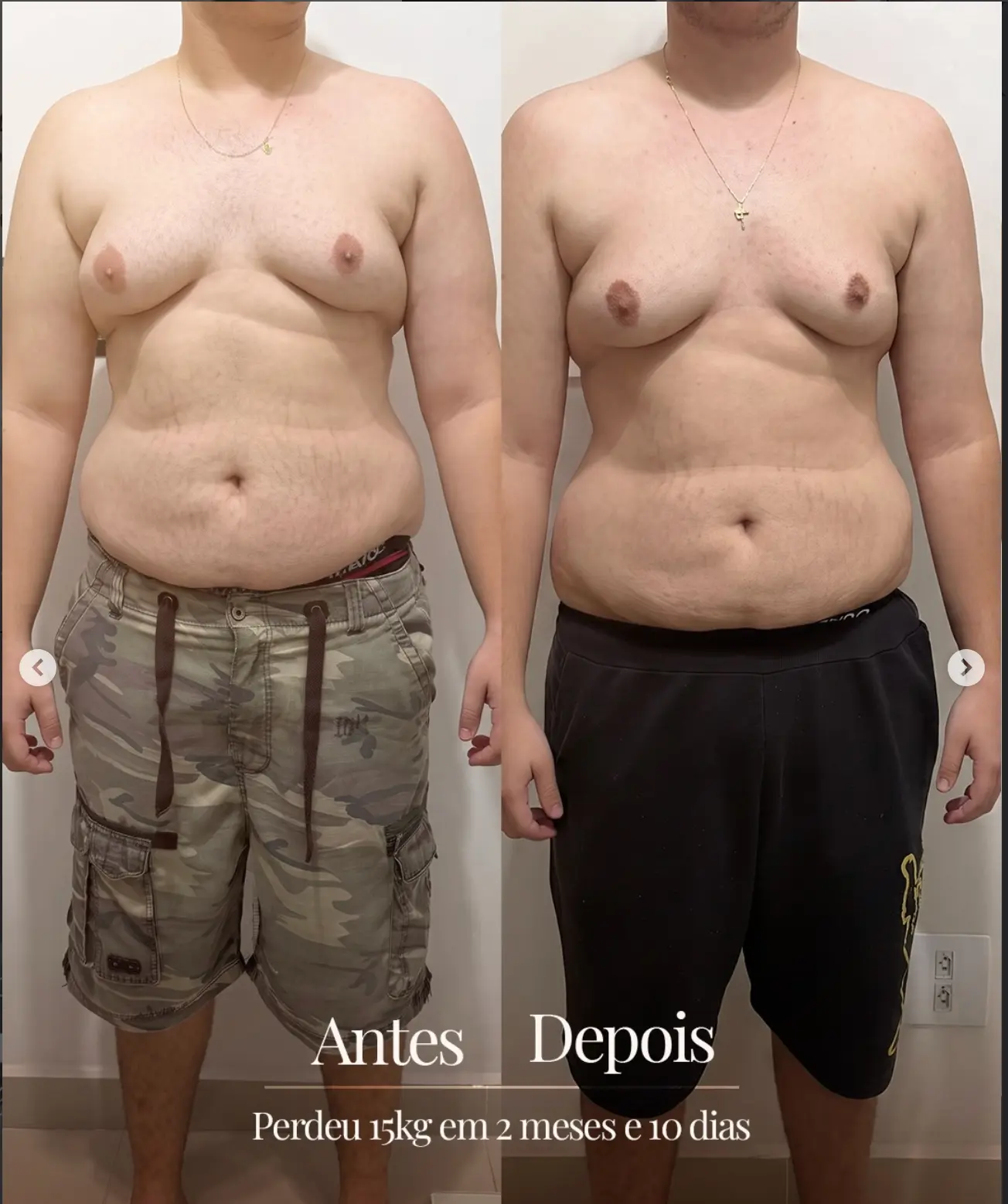 Antes e depois de paciente que perdeu 15kg em 2 meses e 10 dias